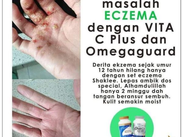 Shaklee Untuk Kulit Gatal