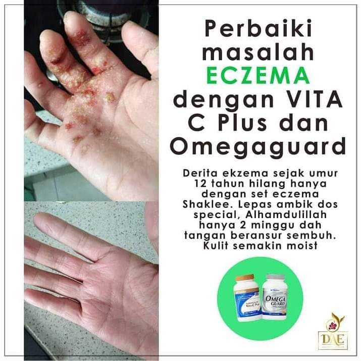 Shaklee Untuk Kulit Gatal